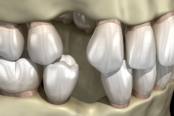 複雑な口腔疾患を抱える方のための全顎治療
