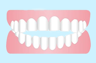 開咬、オープンバイト