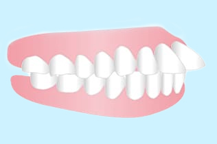 出っ歯、上顎前突