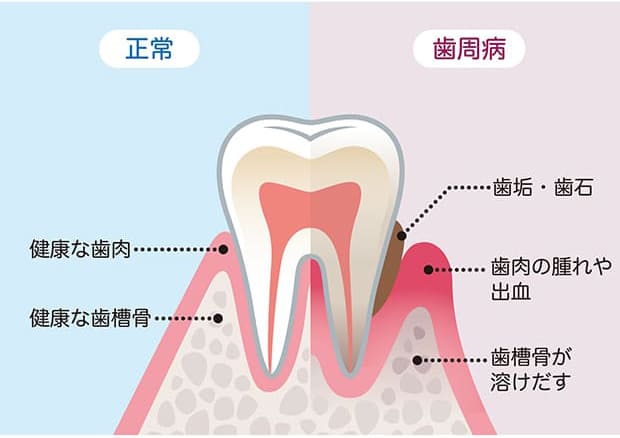 放置すると全身疾患にも関係する歯周病